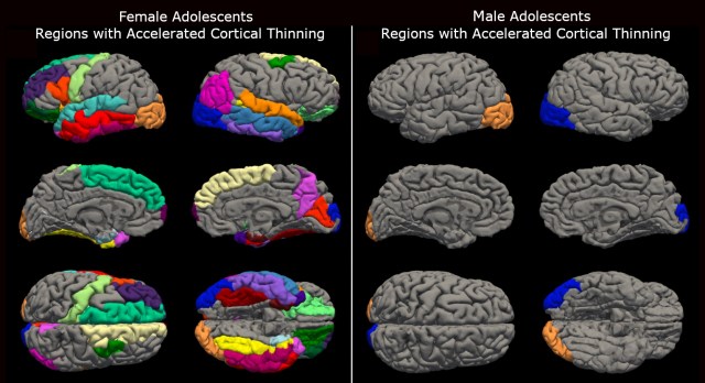 Girls’ brains aged at an ‘accelerated’ rate during the pandemic, study finds