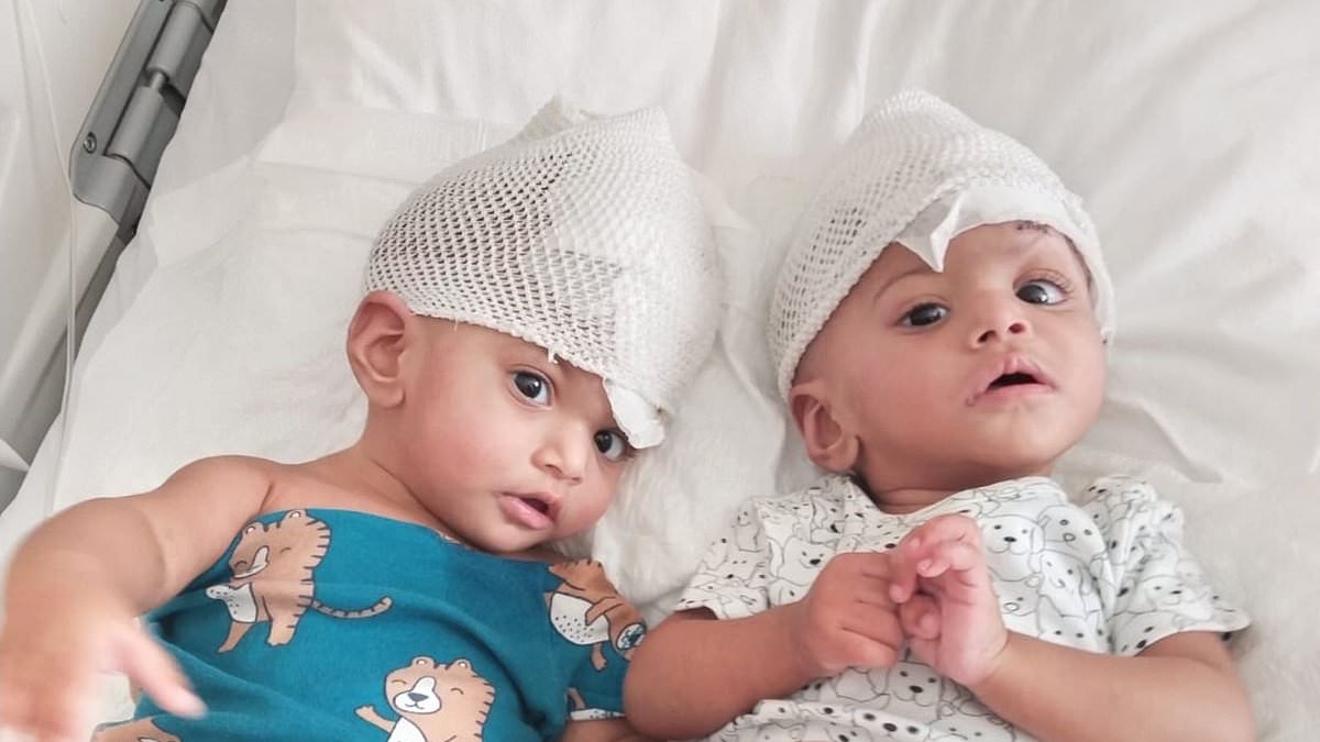 British surgeons successfully separate conjoined twins in radical 14-hour operation