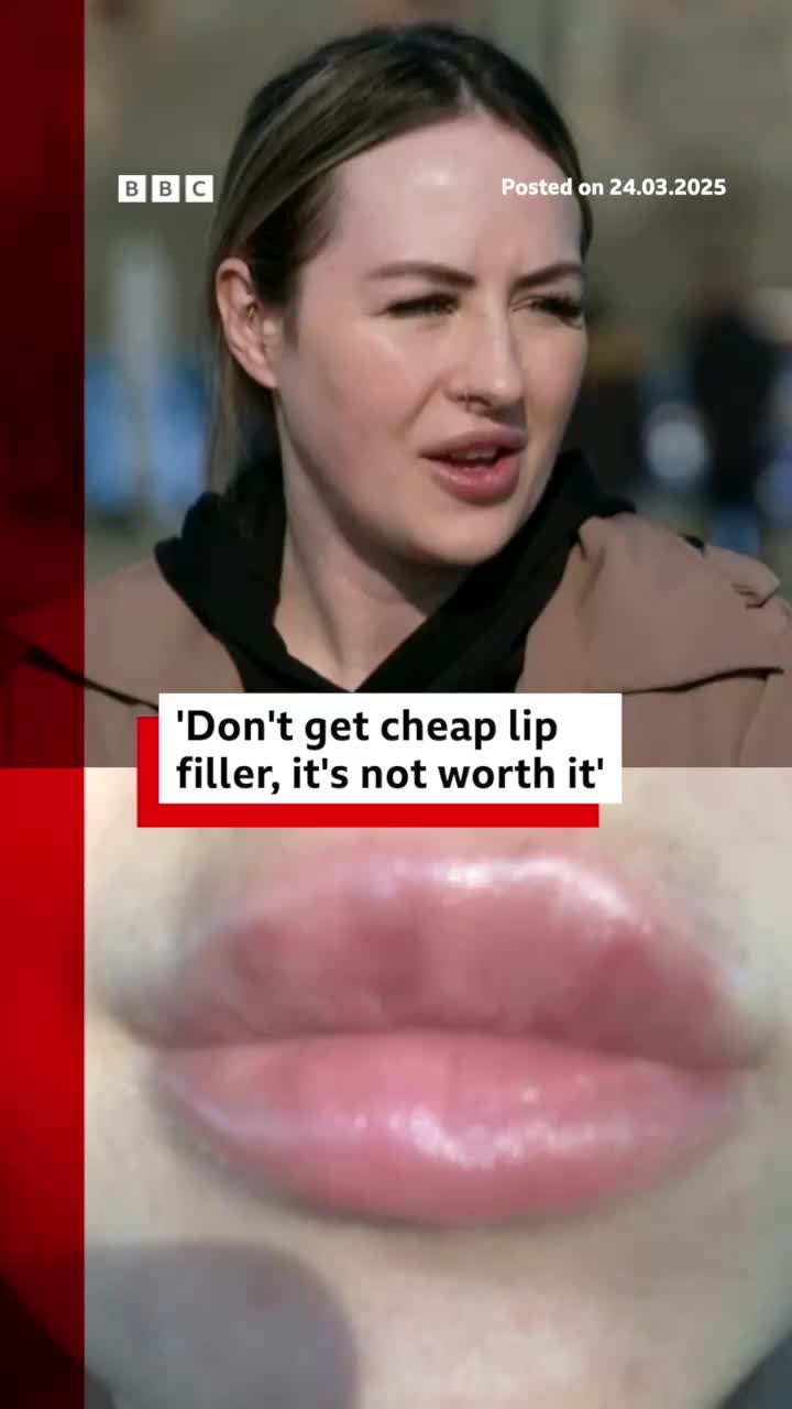 A ban on lip filler and Botox-style injections for under-18s has been introduced in England and there are plans to do the same in Scotland, Wales and the Republic of Ireland - but not in Northern Ireland. #LipFiller #LipFillers #Botox #BotoxInjection #Filler #FillerInjection #NorthernIreland #CosmeticSurgery #News #BBCNews