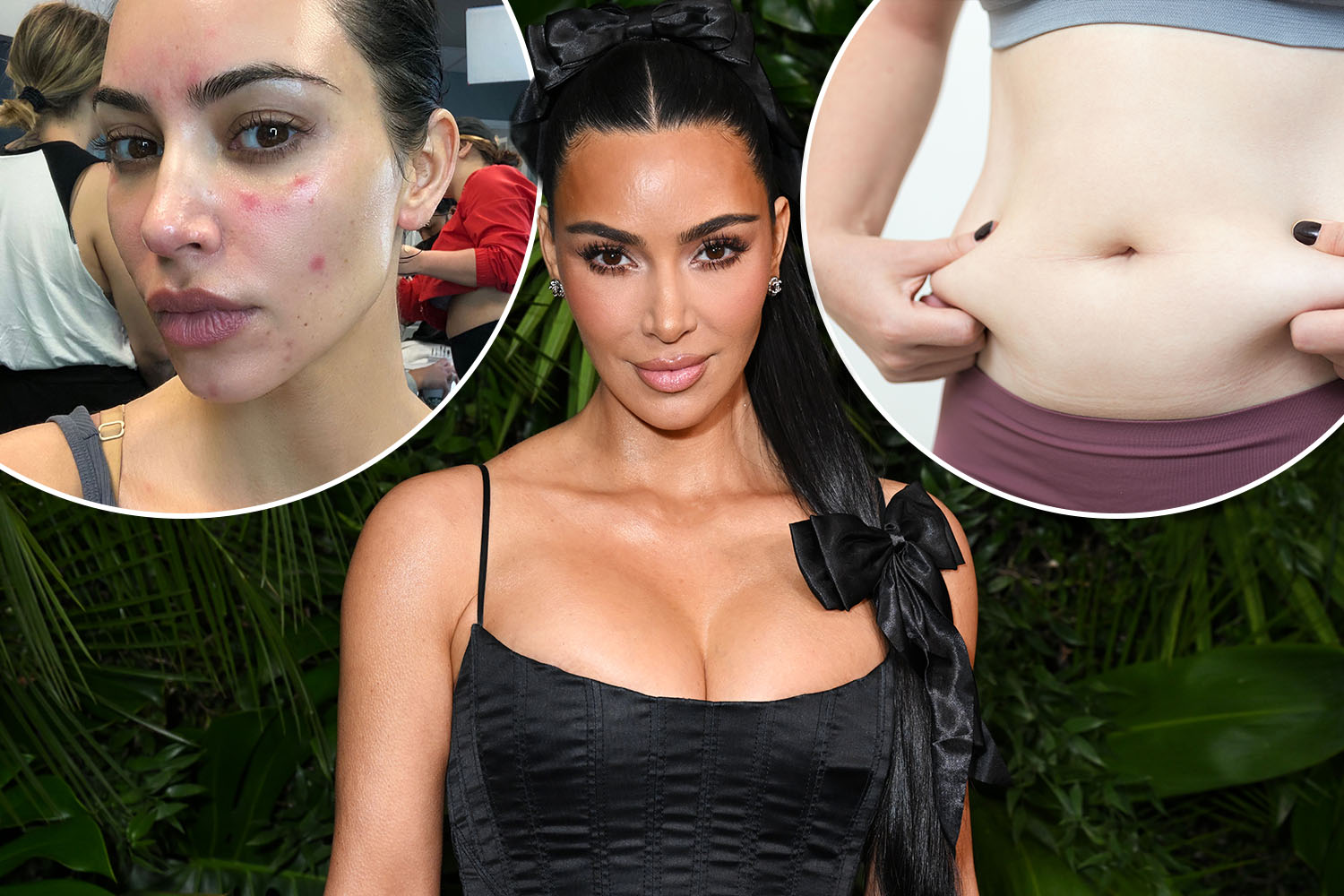 Belly fat 'may cause painful skin condition' suffered by Kim Kardashian