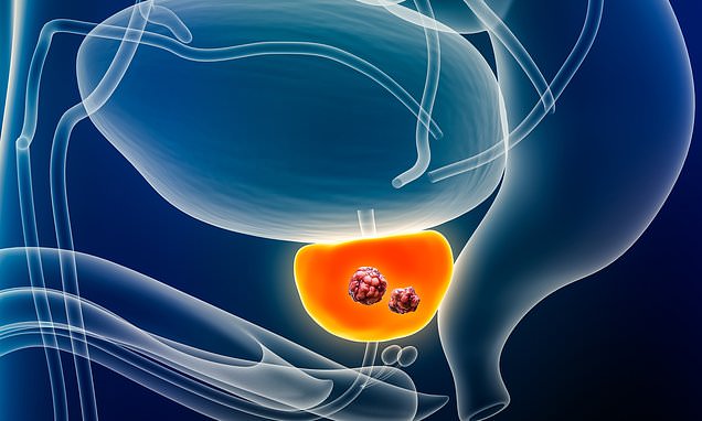 AI could cut risk of dying from prostate cancer by half, says study