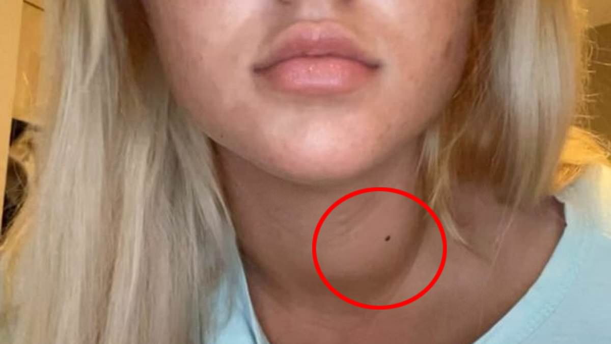 Young woman who was diagnosed with thyroid cancer at just 20 claims GPs dismissed years of symptoms as 'laziness'