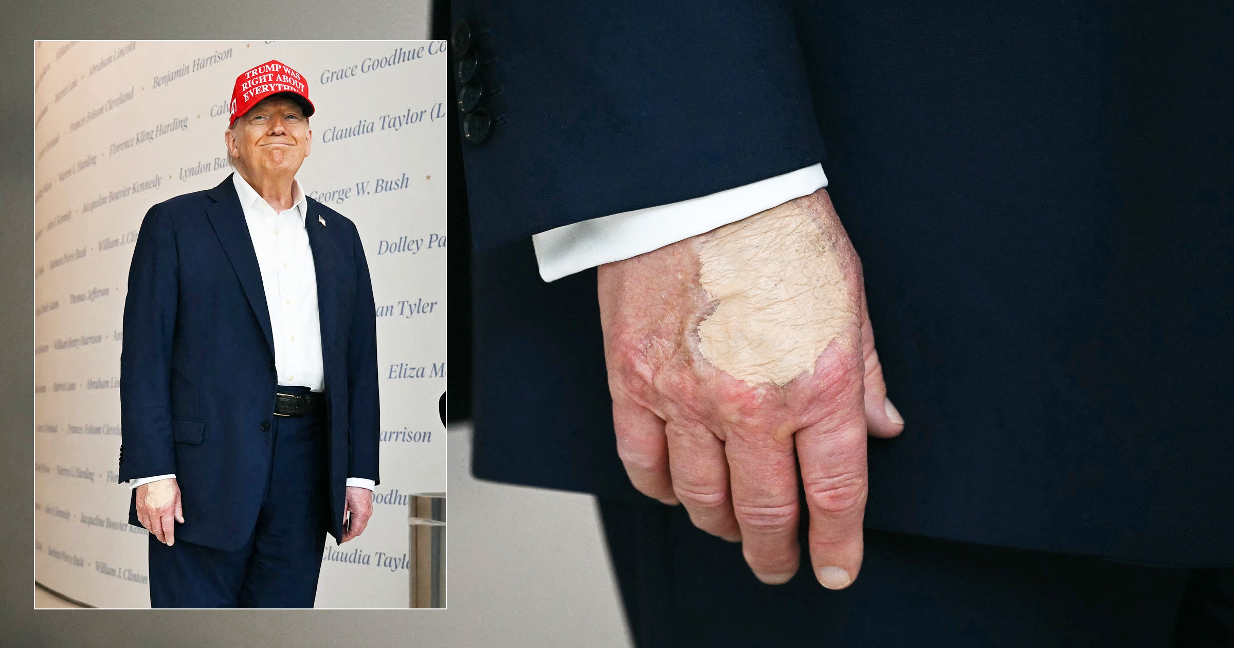 As Health Questions Swirl, Weird Spot Appears on Trump’s Hand