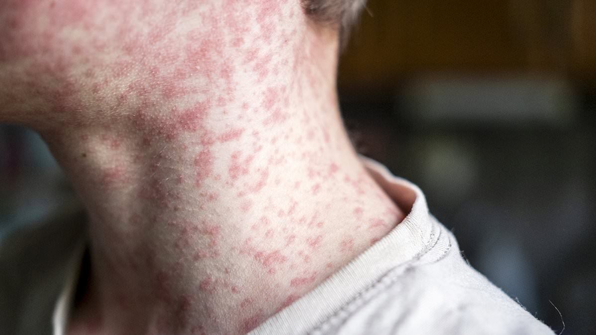 Thousands of people exposed to measles at major sporting event as infections spread