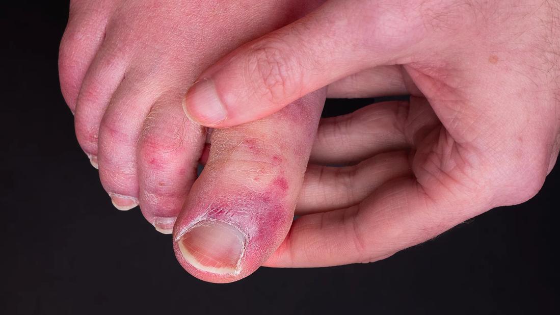 COVID Toes, COVID Rashes and Other Skin Complications: A Quick Guide