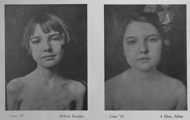 This photo was taken in 1922 of a little girl who was suffering from type 1 diabetes before insulin was available, she was waiting for the end of her life until a new experimental treatment called "Insulin" was used on her which reversed the severe weight loss and saved the girl. [800x507]