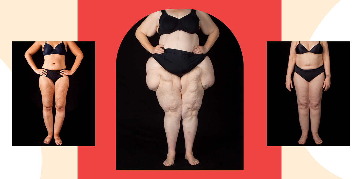 Millions of Women May Have This Painful Condition—and Many Have No Idea It Even Exists